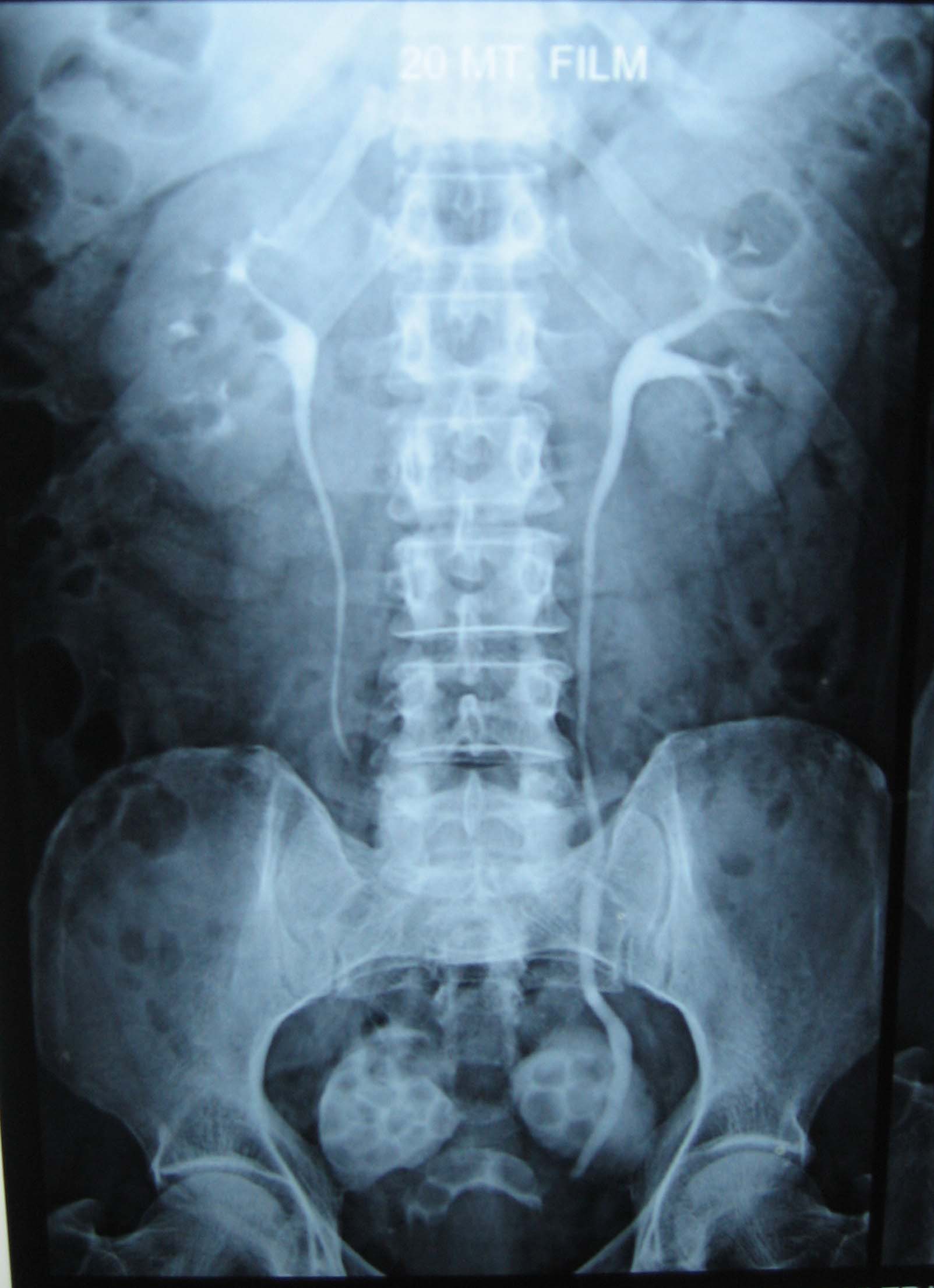 Bilateral Large Diverticulae Of Urinary Bladder